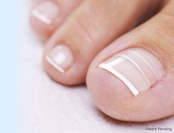 ingrown toenail home treatment from curvecorrect