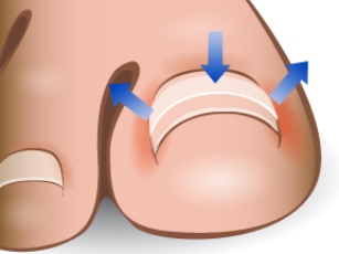 how-to-get-rid-of-an-ingrown-toenail-brace.jpg