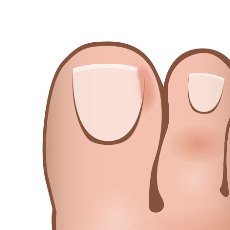 how-to-get-rid-of-ingrown-toenails-trim-off-side.jpg