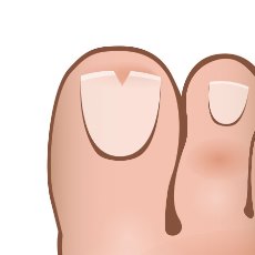 how-to-get-rid-of-ingrown-toenails-v-cut.jpg