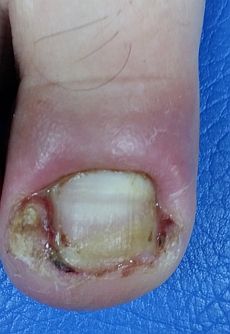 infected-ingrown-toenail.jpg