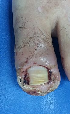 infected-toenail.jpg