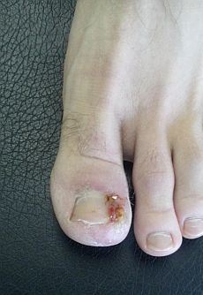 ingrown-toenail-infection-1.jpg