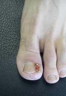 Ingrown Toenail Infection Curvecorrect