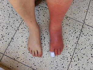 ingrown-toenail-infection-cellulitis.jpg