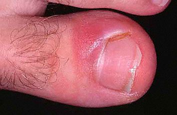 Ingrown Toenail Infection Curvecorrect